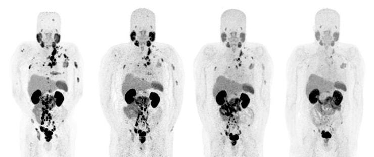 PET scan panel from Fusiomica presentation summary slide